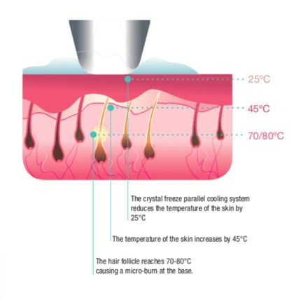 lézeres szőrtelenítés 8